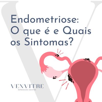 Endometriose O que É Quais os Sintomas